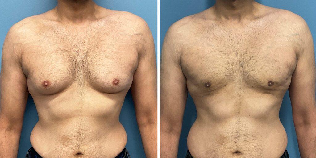 Bluemont Plastic Surgery result — Fairfax, VA