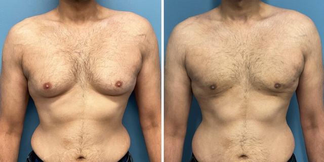 Gynecomastia Surgery result at Bluemont Plastic Surgery in Fairfax, VA