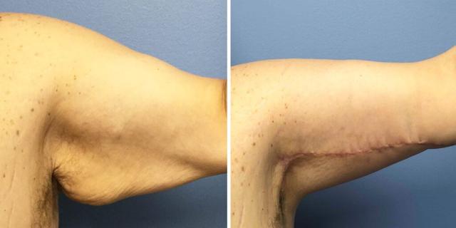 CoolSculpting result at Bluemont Plastic Surgery in Fairfax, VA