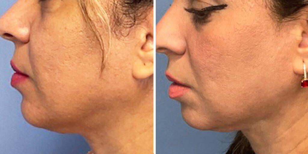Bluemont Plastic Surgery result — Fairfax, VA