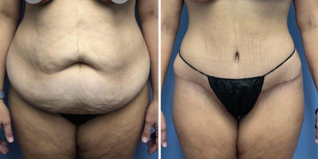 Tummy Tuck result at Bluemont Plastic Surgery in Fairfax, VA