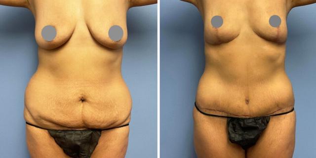 Mommy Makeover result at Bluemont Plastic Surgery in Fairfax, VA