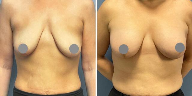 Fat Transfer Breast Augmentation result at Bluemont Plastic Surgery in Fairfax, VA