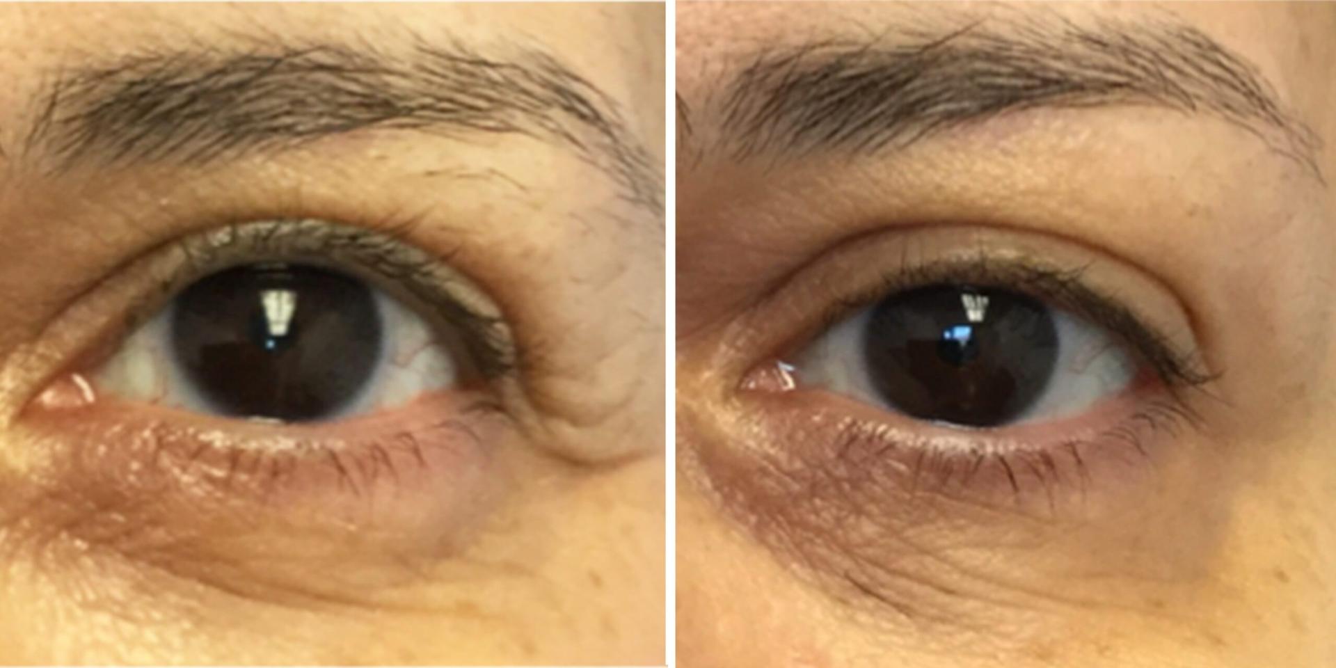 Bluemont Plastic Surgery botox result — Fairfax, VA