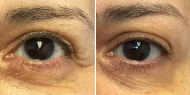 Botox result at Bluemont Plastic Surgery in Fairfax, VA