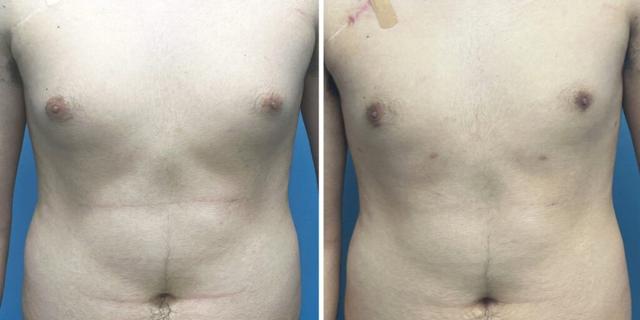 Gynecomastia Surgery result at Bluemont Plastic Surgery in Fairfax, VA