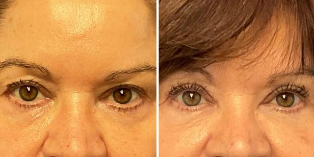 Blepharoplasty result at Bluemont Plastic Surgery in Fairfax, VA