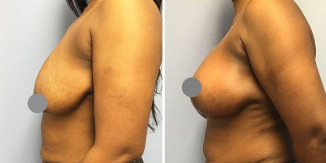 Fat Transfer Breast Augmentation result at Bluemont Plastic Surgery in Fairfax, VA
