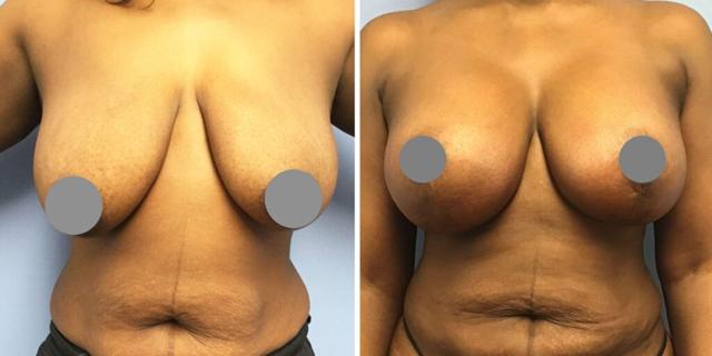 Fat Transfer Breast Augmentation result at Bluemont Plastic Surgery in Fairfax, VA