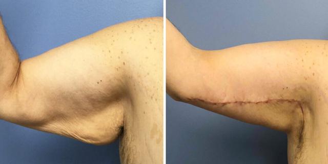 CoolSculpting result at Bluemont Plastic Surgery in Fairfax, VA