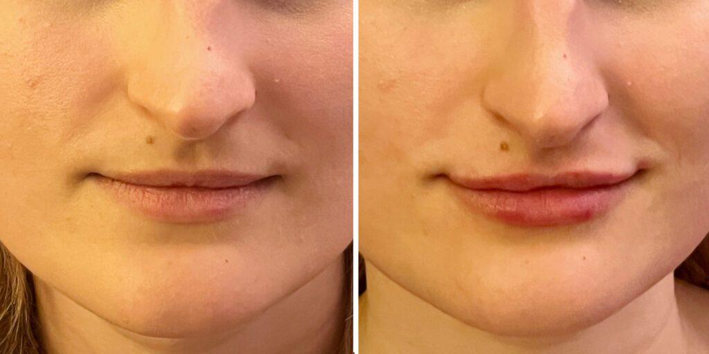 Bluemont Plastic Surgery result — Fairfax, VA