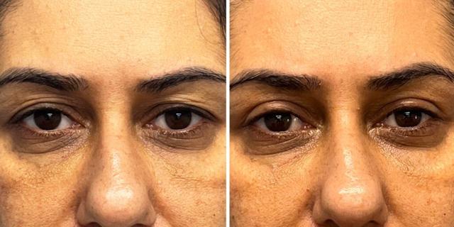 Blepharoplasty result at Bluemont Plastic Surgery in Fairfax, VA