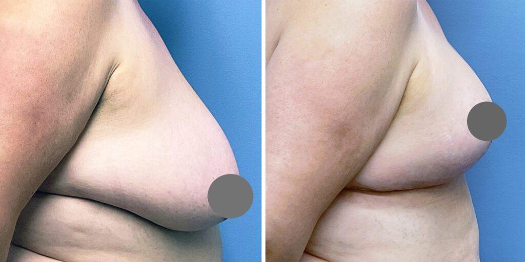 Bluemont Plastic Surgery breast reduction result — Fairfax, VA