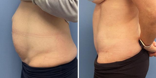 Tummy Tuck result at Bluemont Plastic Surgery in Fairfax, VA