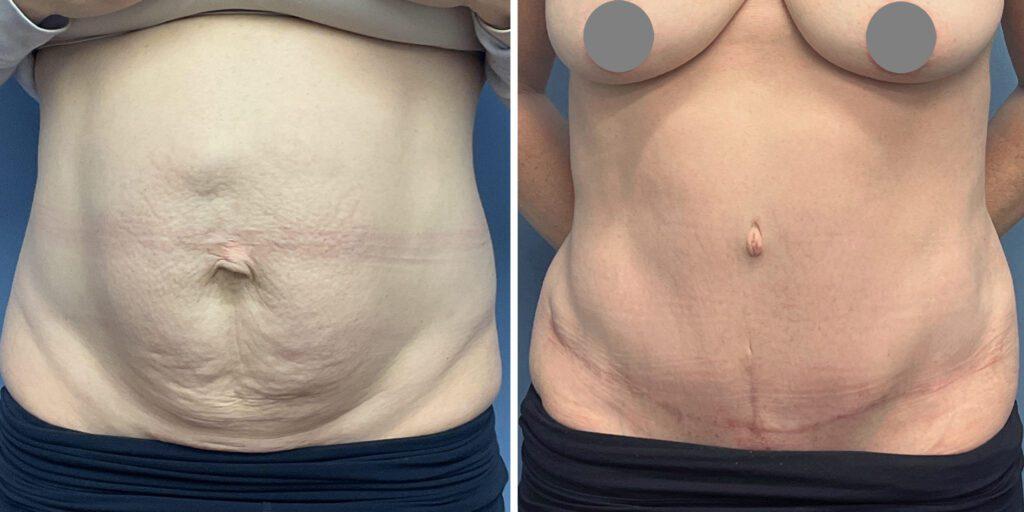 Bluemont Plastic Surgery tummy tuck result — Fairfax, VA