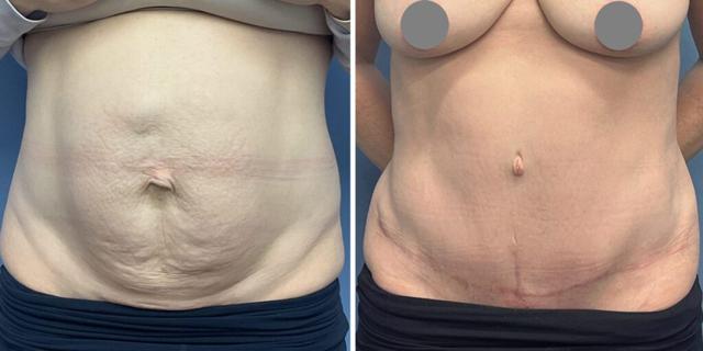 Tummy Tuck result at Bluemont Plastic Surgery in Fairfax, VA