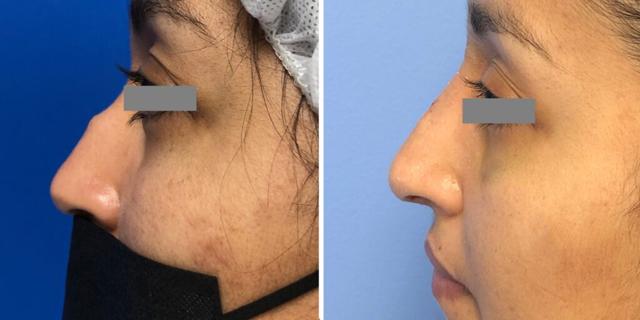 Ethnic Rhinoplasty result at Bluemont Plastic Surgery in Fairfax, VA
