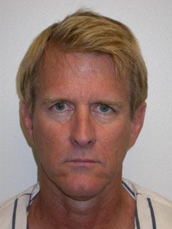 Facelift before at David A. Rosenstein, MD in Boynton Beach, FL
