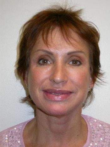 David A. Rosenstein, MD facelift after — Boynton Beach, FL