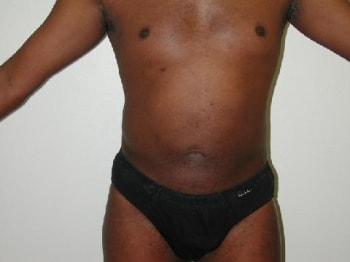 David A. Rosenstein, MD liposuction after — Boynton Beach, FL