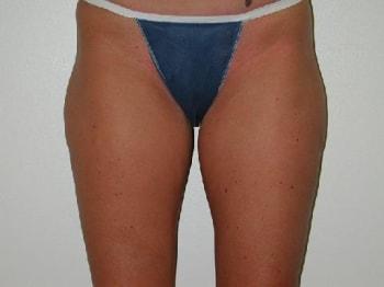 David A. Rosenstein, MD liposuction after — Boynton Beach, FL