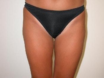 David A. Rosenstein, MD liposuction after — Boynton Beach, FL