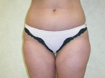 David A. Rosenstein, MD liposuction after — Boynton Beach, FL