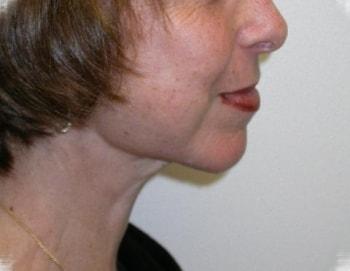 David A. Rosenstein, MD chin implant after — Boynton Beach, FL