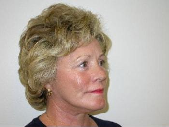 David A. Rosenstein, MD facelift after — Boynton Beach, FL