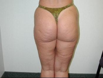 David A. Rosenstein, MD liposuction after — Boynton Beach, FL