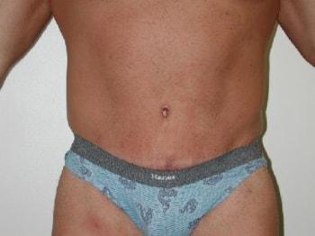David A. Rosenstein, MD tummy tuck after — Boynton Beach, FL
