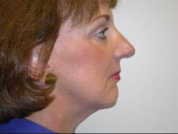 David A. Rosenstein, MD chin implant after — Boynton Beach, FL