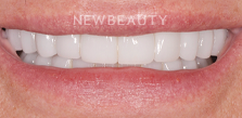 Dr. Salvator La Mastra V dental crowns after — Dallas, TX