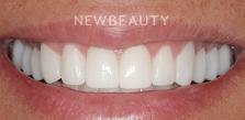 Dr. Salvator La Mastra V dental crowns after — Dallas, TX