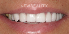 Dental Crowns before at Dr. Salvator La Mastra V in Dallas, TX