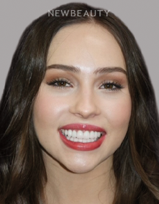Dr. Salvator La Mastra V gum reshaping after — Dallas, TX