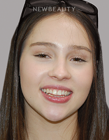 Gum Contouring before at Dr. Salvator La Mastra V in Dallas, TX