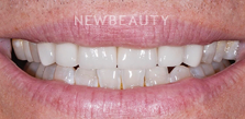 Dr. Salvator La Mastra V gum reshaping after — Dallas, TX