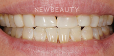 Gum Contouring before at Dr. Salvator La Mastra V in Dallas, TX