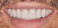 Dr. Salvator La Mastra V dental crowns after — Dallas, TX