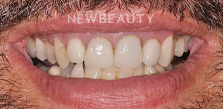 Dental Crowns before at Dr. Salvator La Mastra V in Dallas, TX