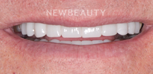 Dr. Salvator La Mastra V gum reshaping after — Dallas, TX