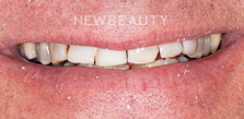 Gum Contouring before at Dr. Salvator La Mastra V in Dallas, TX