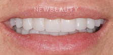 Dr. Salvator La Mastra V dental crowns after — Dallas, TX