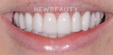 Gum Contouring after at Dr. Salvator La Mastra V in Dallas, TX