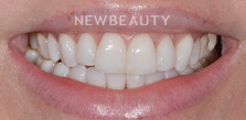 Gum Contouring before at Dr. Salvator La Mastra V in Dallas, TX