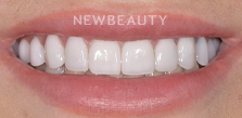 Dr. Salvator La Mastra V gum reshaping after — Dallas, TX