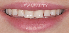 Gum Contouring before at Dr. Salvator La Mastra V in Dallas, TX