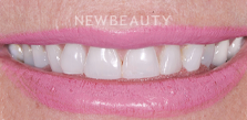 Smile Makeover before at Dr. Salvator La Mastra V in Dallas, TX