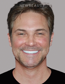 Dr. Salvator La Mastra V dental crowns after — Dallas, TX